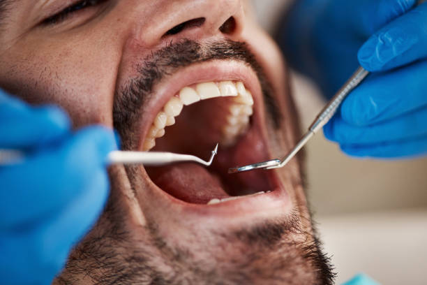 Best Emergency Tooth Extraction in Herriman, UT