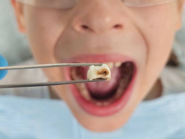Best Emergency Dental Care for Broken or Chipped Teeth in Herriman, UT